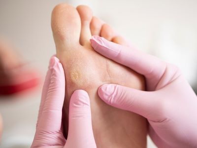 Foot-Corns-and-Calluses-Shoreline